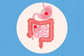 Illustration of the human digestive tract with emphasis on the intestines showing inflamed areas